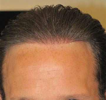 Exoderm Hair Implant